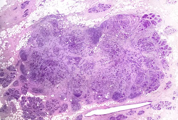 stock image Breast ductal carcinoma. Very low magnification light micrograph showing irregular cords and nests of malignant ductal carcinoma cells invading breast stroma.