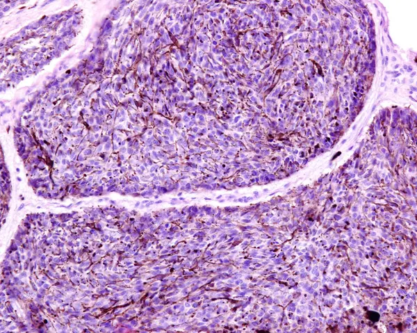 人类的皮肤 色素基底细胞癌的光镜表现 这是基底细胞癌罕见的亚型 表现为黑色素沉着 表皮基底角质细胞与类似黑素细胞的色素细胞混合 免版税图库图片