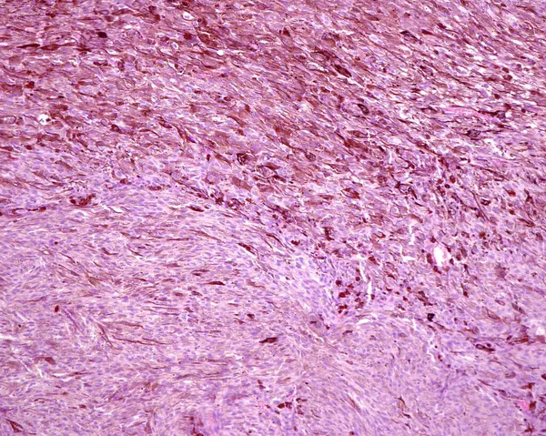 黑色素瘤是所有皮肤癌中最致命的一种 它的光学显微镜摄像与在阳光下暴露于紫外线辐射所导致的后天突变密切相关 肿瘤是由梭形恶性细胞的链状排列而形成的 免版税图库照片