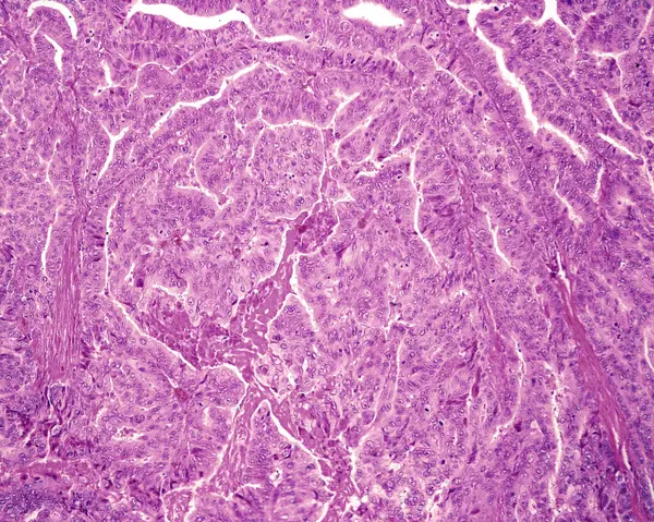 卵巢癌是最常见的上皮性卵巢癌 高水平的浆液癌占所有上皮卵巢癌的75 从组织学上看 该模式与乳头状或实性生长模式具有异质性 那个肿块 免版税图库照片