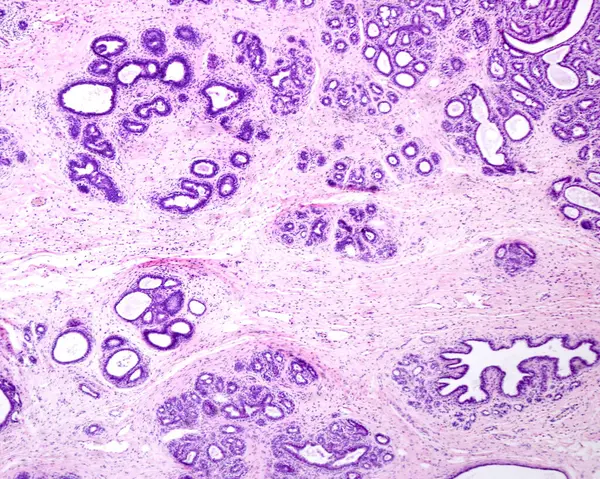 Adenosis Mamaria Humana Micrografía Ligera Adenosis Cambio Benigno Que Consiste Fotos De Stock