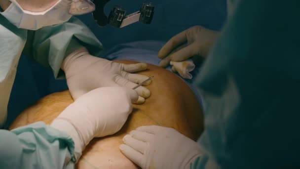 两名男医生手切手术刀在医院门诊病人腹部开刀腹部整形手术剖腹产手术剖宫产手术药物急诊 — 图库视频影像