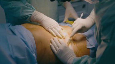 İki doktor erkek cerrah doktor hastaya estetik cerrahi karın ameliyatında yardım ediyor liposuction anestezi enjeksiyonu tıbbi şırınga acil tıp cerrahi cerrahi operasyonu hastane kliniğinde