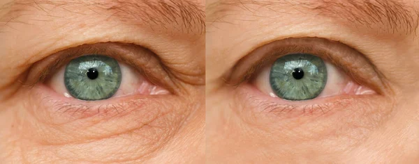 close up part of face mature woman 55 years old, human eye, lower, upper eyelid, deep wrinkles around eyes, age-related skin changes, Before and after cosmetic cosmetic anti-aging procedures