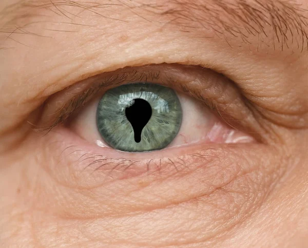 虹彩の先天性Colaboma 梨状の黒い斑点 染色体異常 遺伝性の低さ ランダムな遺伝子変異 組織膜の目の欠陥が形で発生する眼科疾患Cleft — ストック写真