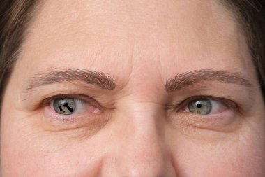 congenital colaboma of iris, pear-shaped black spot, chromosomal abnormalities, poor heredity, random genetic mutation, ophthalmic disease in which defect in tissues membranes eye occurs in form cleft