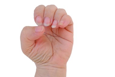 closeup of bitten and brittle nails without manicure, female hand with overgrown cuticle fingernails and tainted nail plate, cuticle overgrown nails, concept of nail care and health