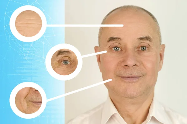 Elderly Caucasian Male Face Puffiness Eyes Wrinkles Cosmetic Procedures Treatment — Stok Foto