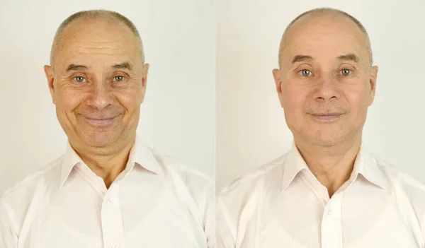 Elderly Caucasian Male Face Puffiness Eyes Wrinkles Treatment Two Shots — 스톡 사진