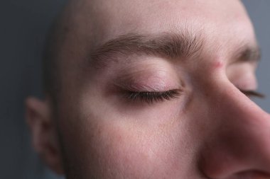 Erkek yüzünün bir kısmını kapat, adam, 25-30 yaşlarında genç adam gözlerini kapat, burun köprüsünde kırmızı sivilce, problem kavramı, kozmetik prosedürler, cilt sağlığı, güzellik kliniği hastası