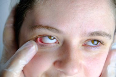 Dişçi, doktor, kadın hastaların hassas, hastalıklı gözlerini iyileştirir, yüzünün yakın kısmında genç bir kadın, göz kapağında tümör olan bir hastanın konsept muayenesi, teşhis ve neoplazma tedavisi