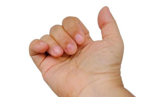 Closeup Bitten Brittle Nails Manicure Female Hand Overgrown Cuticle Fingernails — Φωτογραφία Αρχείου
