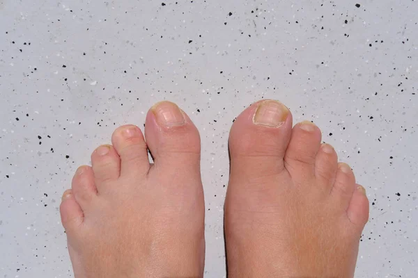 오른쪽 발가락에 염증이 생기고 확대되고 마티스 관절염 골격계 — 스톡 사진