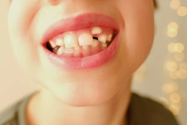 特写假牙 10岁男孩张嘴 8岁儿童露出牙齿 到牙医那里检查口腔 控制磨牙 临时牙齿 防止龋的概念 — 图库照片