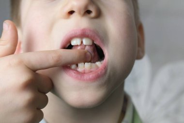 Küçük hasta, çocuk, çocuk... 7 yıl boyunca ağzı açık kalmış... dil dokunuşları, terapi egzersizleri, konuşma bozuklukları, düzeltme, dil çılgınlığı... kavrama, iletişim sorunları gibi beceriler geliştirdi.