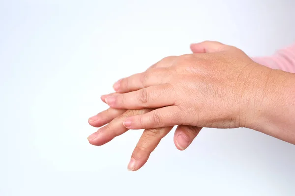 閉じた女性の手55乾燥肌の損傷を持つ歳 保湿剤を適用します コンセプトケア老化肌 治療皮膚科疾患 表皮の水分補給と栄養 年齢関連の肌の変化 — ストック写真
