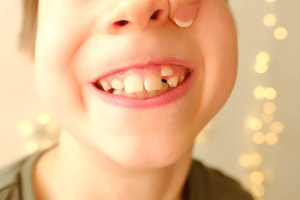 Closeup Dentes Tortos Menino Anos Boca Aberta Criança Anos Mostra — Fotografia de Stock