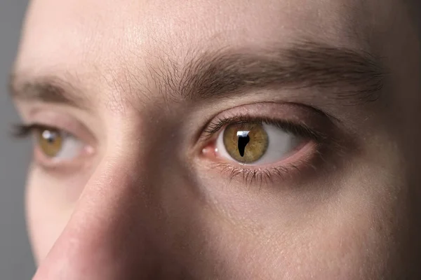 虹彩の先天性Colaboma 梨状の黒い斑点 染色体異常 遺伝性の低さ ランダムな遺伝子変異 組織膜の目の欠陥が形で発生する眼科疾患Cleft — ストック写真