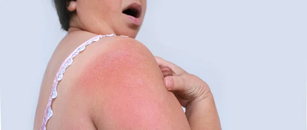 日焼けした皮膚を持つ女性の肩の一部のクローズアップ 大人の女性患者 女性は痛みに苦しんでいます 皮膚の瘢痕化 医療の概念 ヘルスケア ヒト組織再生 — ストック写真