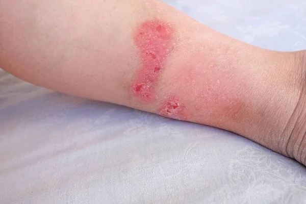 Gran Herida Fresca Parte Inferior Pierna Con Cicatrices Paciente Mujer — Foto de Stock