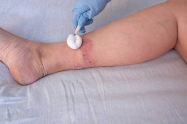 Doktor alt bacağındaki büyük iyileşme yaralarını yetişkin kadın hastaların yaralarıyla, kızarıklıklarla, deri yaralarıyla, tıbbi bakım konseptiyle, insan dokusu rejenerasyonuyla, kadın ayaklarında haşlanmayla tedavi ediyor.