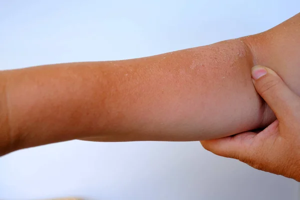 Sunburn Skin Exfoliation Epithelium Severe Peeling Skin Sunburn Hands Elderly — Stock Photo, Image