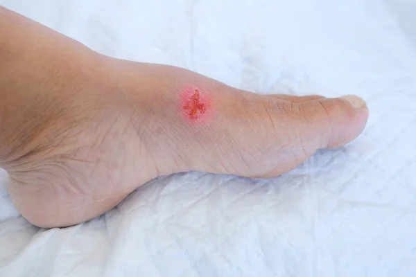Крупный План Плачущей Раны Термический Ожог Трофическая Язва Женской Ноге — стоковое фото