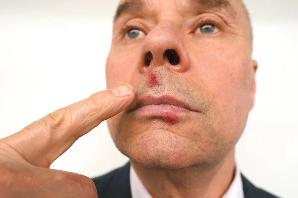 カリスマ成熟した男性のクローズアップ シニア60歳は慎重に唇にヘルペスを調べます 鼻の下 特定の水疱 皮膚上のウイルス性疾患 — ストック写真