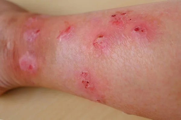 Closeup Weeping Wounds Venous Ulcers Female Leg Diabetes Mellitus Varicose — Stock Photo, Image