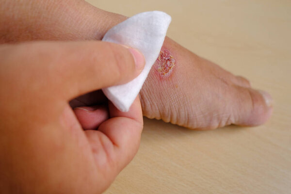 closeup of weeping wound, trophic ulcer on female leg, wound exudate prevents healing ulcers by destroying growth factors, concept of self-treatment at home, sanitation pathogenic microflora