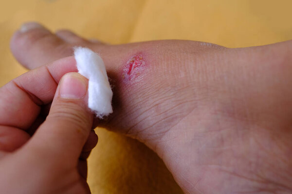 closeup of weeping wound, trophic ulcer on female leg, wound exudate prevents healing ulcers by destroying growth factors, concept of self-treatment at home, sanitation pathogenic microflora