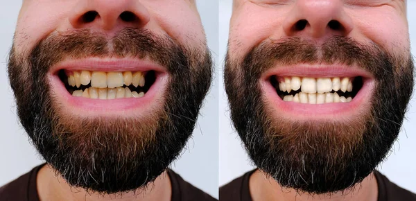 閉じて歯 患者の口腔 歯の白化 前と後の手順 カリスマひげを生やした若い男30 2つのバージョンで口を開けて歳 歯磨き粉の選択 ケアと衛生 — ストック写真