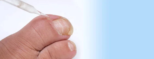 close-up of damaged rude nail on big toe of female foot, exfoliation, nail fungus, treatment Nail onycholysis, Paramedical, Medical pedicure, aging problems, female age, Treatment by dermatologist
