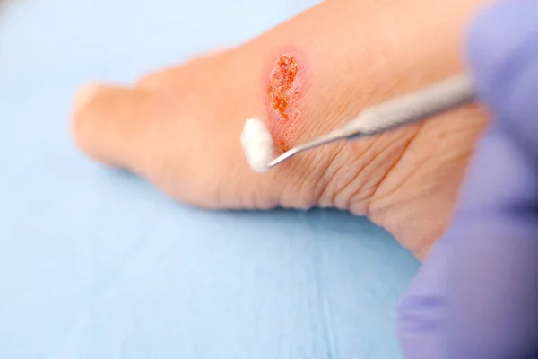 Γιατρός Αντιμετωπίζει Κλάμα Πληγή Τροφικό Έλκος Στο Γυναικείο Πόδι Πληγή — Φωτογραφία Αρχείου