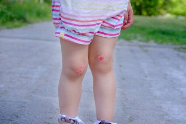 fresh wound, bleeding abrasion on knees of girl child fell on walk, traumatic safety concept for children, treatment of injuries, medical care, hyperactivity of children, bacterial contamination
