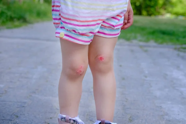 Fresh Wound Bleeding Abrasion Knees Girl Child Fell Walk Traumatic — Zdjęcie stockowe
