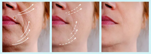 50岁妇女面部特写部分 有年龄较大的皱纹 治疗前后的面部皱纹 化妆品的概念 抗衰老传单 — 图库照片