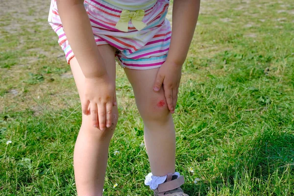 Fresh Wound Bleeding Abrasion Knees Girl Child Fell Walk Traumatic — Stock Photo, Image
