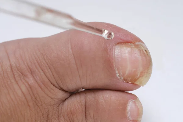 Dermatologist Dermatovenereologist Podologist Treats Damaged Rude Nail Big Toe Female — Stock Photo, Image