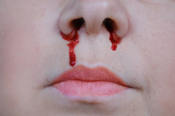 Leuchtend Rotes Blut Fließt Aus Dem Nasenloch Leuchtend Rotes Blut — Stockfoto