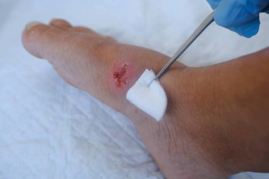 Doktor gözyaşı yaralarını tedavi eder, kadın bacağında iltihaplı ülser, yaranın çıkıntısı büyüme faktörlerini yok ederek ülserlerin iyileşmesini engeller, iltihaplanma sürecini ortadan kaldırır, hijyenik mikroflora