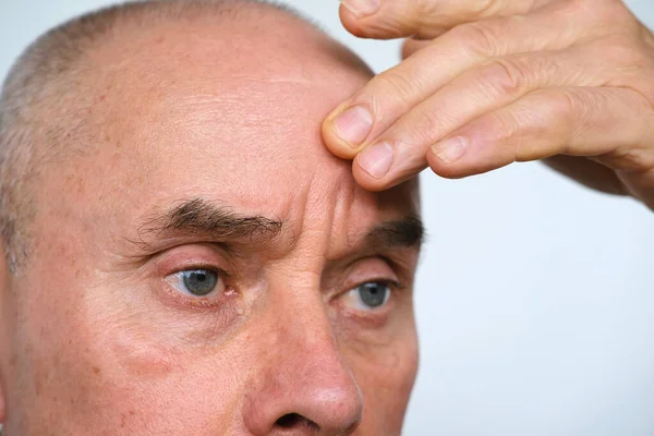 60歳以上の成人男性のクローズアップは 目の周りのしわ 眉毛の間の皮膚 年齢関連の変化 審美的な注射美容 ケアアンチエイジング手順を慎重に検討しています — ストック写真