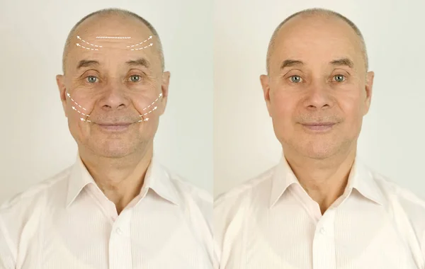 Elderly Caucasian Male Face Puffiness Eyes Wrinkles Treatment Two Shots — 图库照片