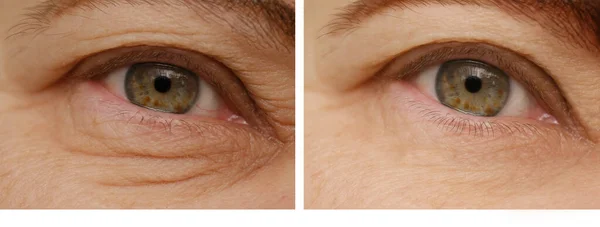 面部的特写部分成熟妇女55岁 上眼睑 眼部周围皱纹很深 皮肤变化前后 化妆品抗衰老程序 视力检查 近视矫正 — 图库照片