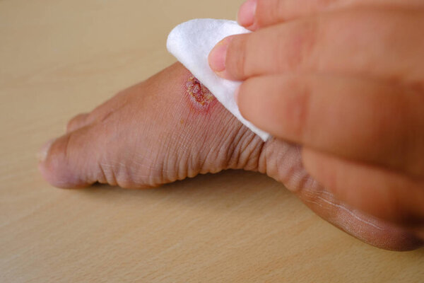 treatment weeping wound, trophic ulcer on female leg, wound exudate prevents healing ulcers by destroying growth factors, concept eliminating inflammatory process, sanitation pathogenic microflora