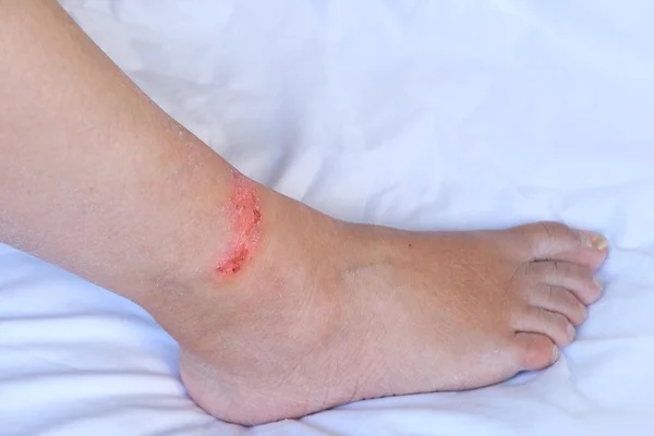 Közeli Bőr Krónikus Dermatitisszel Seb Fájdalmas Női Lábon Orvosi Fogalom — Stock Fotó