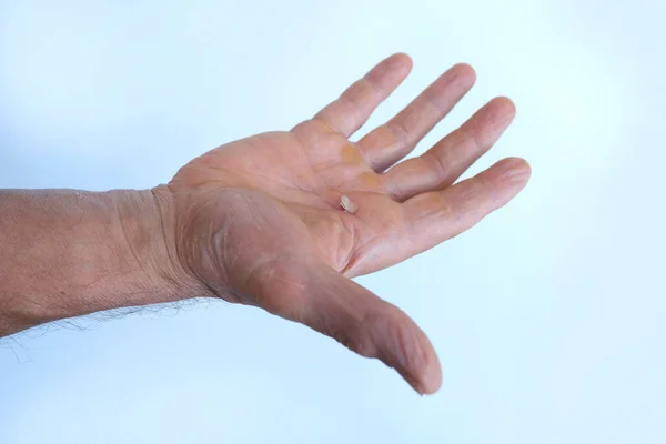 痛みを伴う男性の手に傷を持つクローズアップ皮膚 ヤシの原因破裂 ラフツールと皮膚の摩擦 スポーツ機器 呼吸器除去 手の保護 リハビリテーション 痛みの救済 — ストック写真