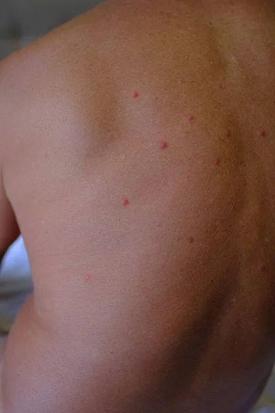Zbliżenie Rannych Pleców Mężczyzny Skóra Ugryziona Przez Komary Swędzące Wysypki — Zdjęcie stockowe