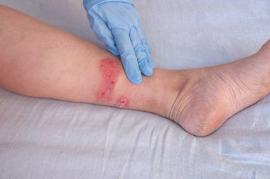 Doktor alt bacağındaki büyük iyileşme yaralarını yetişkin kadın hastaların yaralarıyla, kızarıklıklarla, deri yaralarıyla, tıbbi bakım konseptiyle, insan dokusu rejenerasyonuyla, kadın ayaklarında haşlanmayla tedavi ediyor.