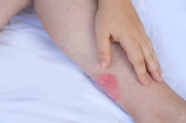 Kronik deri iltihabı, acı veren kadın bacağında yara, tıbbi konsept, kronik durum, dermatolojik bozukluk, deri sorunu, etkilenen bölge.